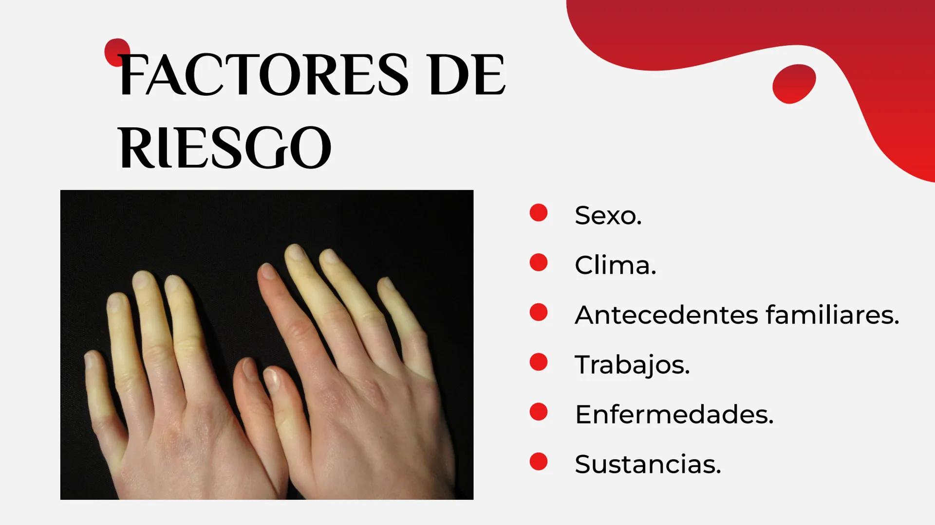 LA HEMOFILIA
ENFERMEDAD DE
RAYNAUD
Y LA ÍNDICE
01
Hemofilia
02
Enfermedad de
Raynaud 01
LA HEMOFILIA oooooo,
¿QUÉ ES?
CAUSAS
TIPOS
FACTORES 