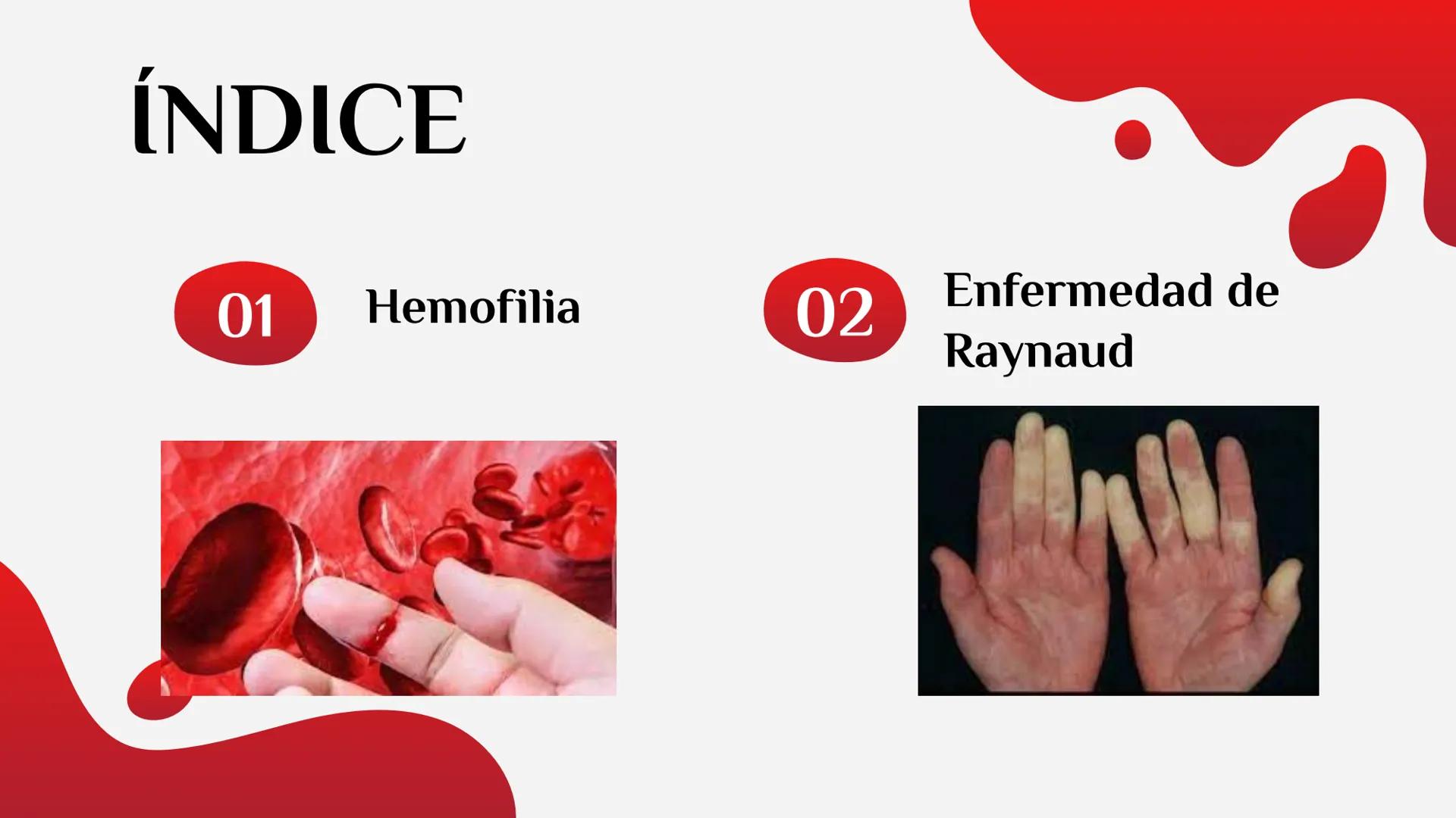 LA HEMOFILIA
ENFERMEDAD DE
RAYNAUD
Y LA ÍNDICE
01
Hemofilia
02
Enfermedad de
Raynaud 01
LA HEMOFILIA oooooo,
¿QUÉ ES?
CAUSAS
TIPOS
FACTORES 