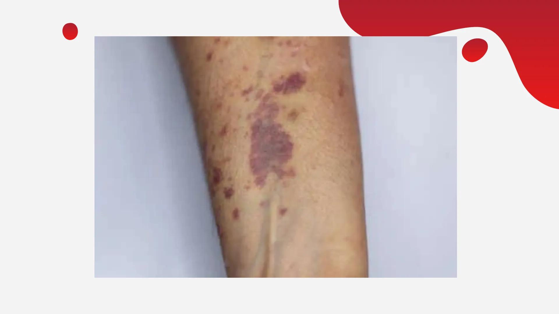 LA HEMOFILIA
ENFERMEDAD DE
RAYNAUD
Y LA ÍNDICE
01
Hemofilia
02
Enfermedad de
Raynaud 01
LA HEMOFILIA oooooo,
¿QUÉ ES?
CAUSAS
TIPOS
FACTORES 