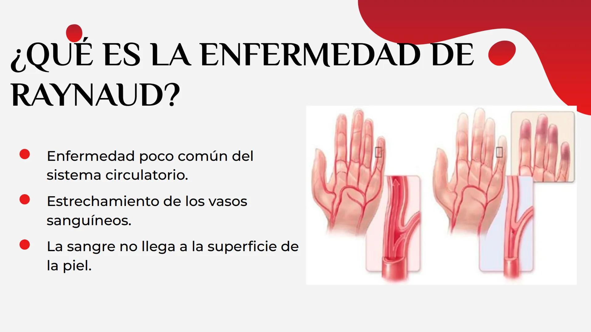 LA HEMOFILIA
ENFERMEDAD DE
RAYNAUD
Y LA ÍNDICE
01
Hemofilia
02
Enfermedad de
Raynaud 01
LA HEMOFILIA oooooo,
¿QUÉ ES?
CAUSAS
TIPOS
FACTORES 