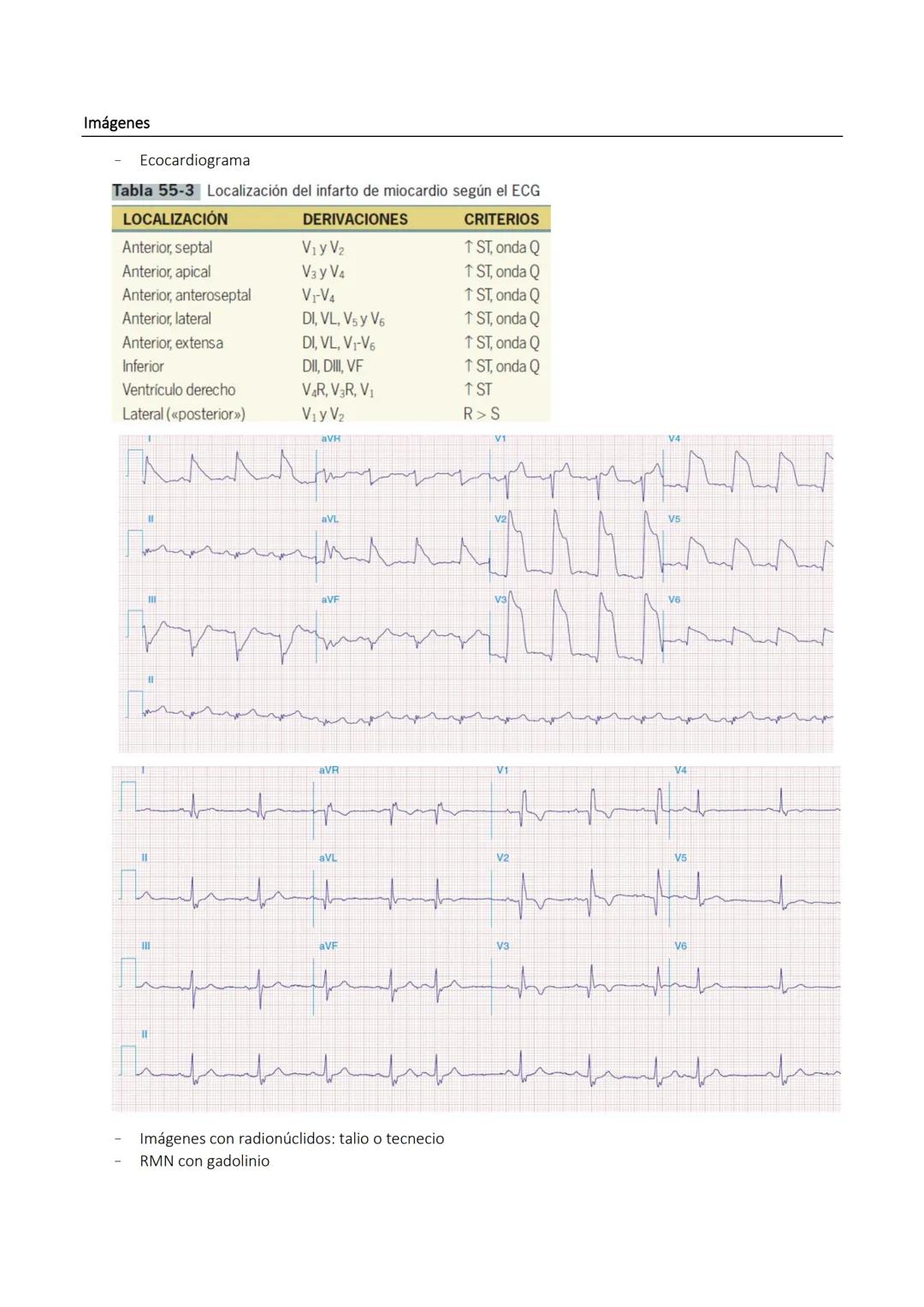 CARDIOPATIA ISQUEMICA
Es un trastorno en el cual parte del miocardio recibe una cantidad insuficiente de sangre y oxígeno; surge
cuando hay 