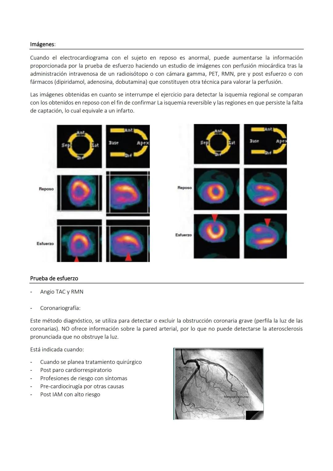 CARDIOPATIA ISQUEMICA
Es un trastorno en el cual parte del miocardio recibe una cantidad insuficiente de sangre y oxígeno; surge
cuando hay 